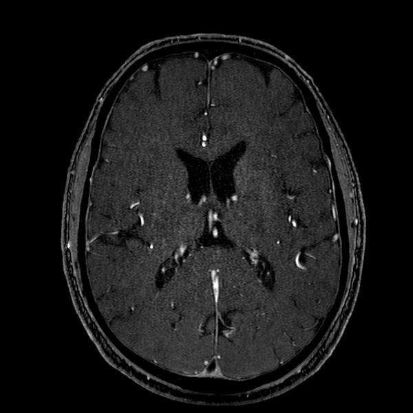 File:Accessory middle cerebral artery (Radiopaedia 73114-83828 Axial MRA 121).jpg