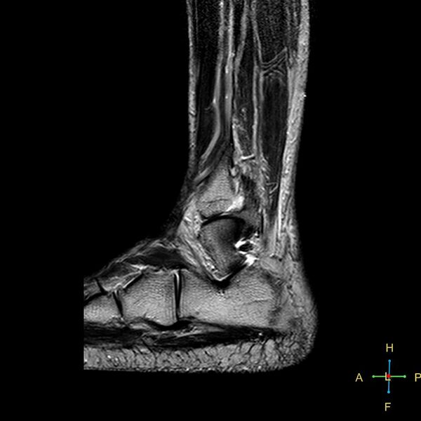 File:Achilles tendon complete tear (Radiopaedia 22834-22854 Sagittal T2 4).jpg