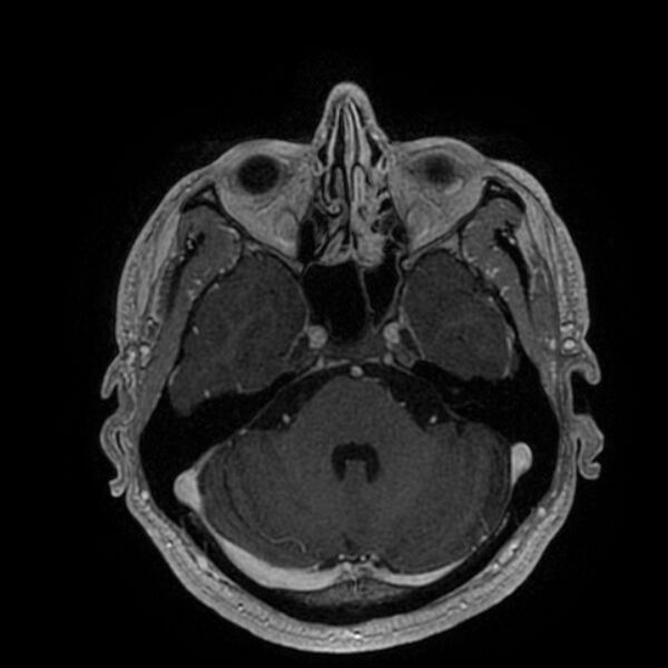 File:Acoustic schwannoma - intracanalicular (Radiopaedia 37247-39024 Axial T1 C+ 74).jpg