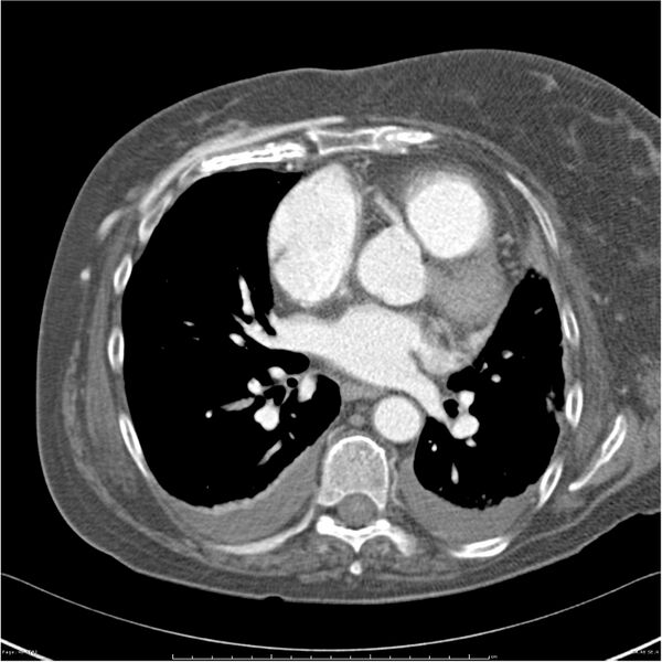 File:Acute-on-chronic pulmonary emboli (Radiopaedia 27925-28169 C+ CTPA 46).jpg