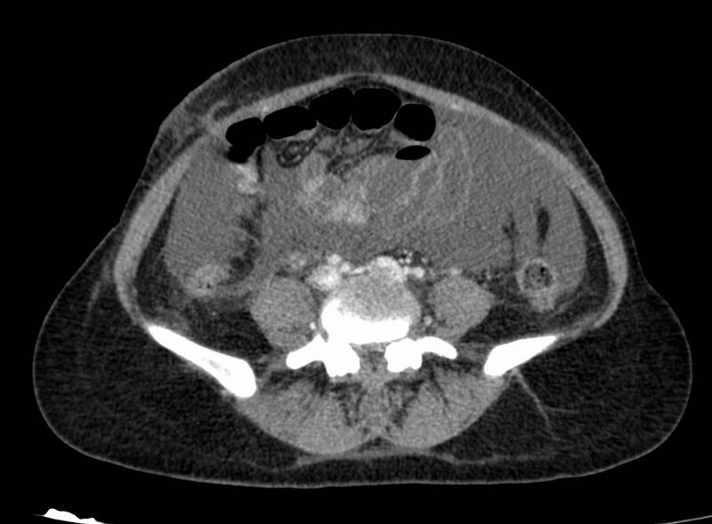 File:Acute Budd-Chiari syndrome (Radiopaedia 60858-68638 Axial C+ portal venous phase 201).jpg