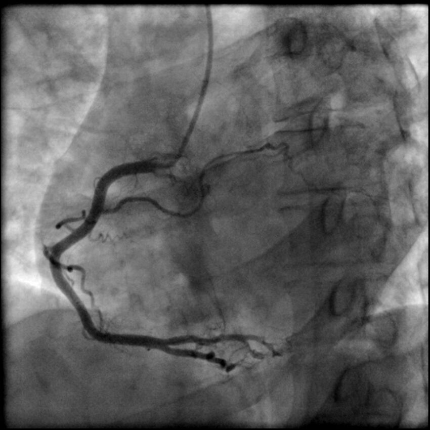 Acute anteroseptal myocardial infarction (Radiopaedia 68409-77946 RAO straight RCA 30).jpg
