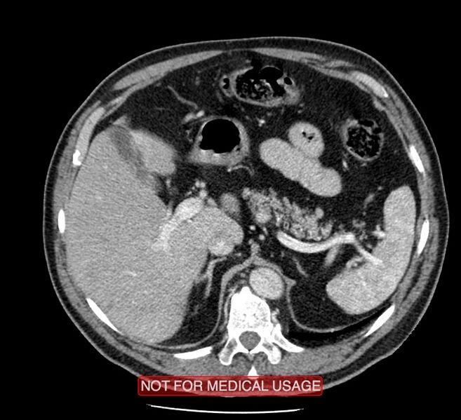 File:Acute aortic dissection - Stanford type A (Radiopaedia 40661-43285 Axial C+ portal venous phase 73).jpg