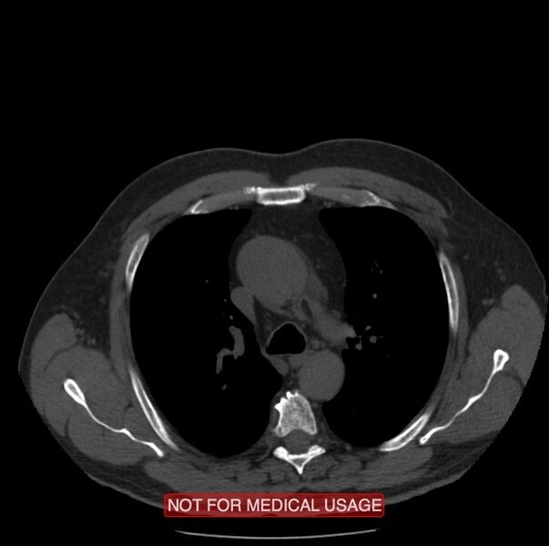 File:Acute aortic dissection - Stanford type A (Radiopaedia 40661-43285 Axial non-contrast 13).jpg