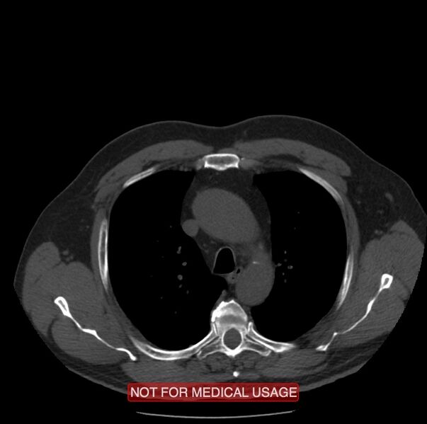 File:Acute aortic dissection - Stanford type A (Radiopaedia 40661-43285 Axial non-contrast 8).jpg