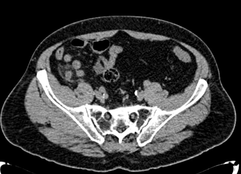 File:Acute appendicitis (Radiopaedia 13030-13091 Axial non-contrast 44).jpg
