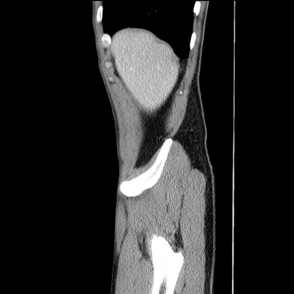 File:Acute appendicitis (Radiopaedia 27049-27227 Sagittal C+ portal venous phase 8).jpg