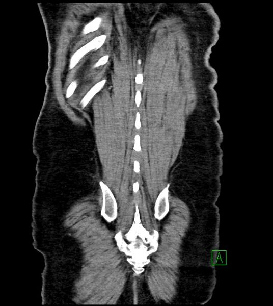 File:Acute arterial mesenteric ischemia (Radiopaedia 78238-90828 Coronal C+ portal venous phase 81).jpg