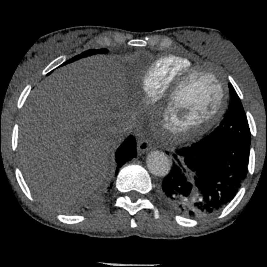 Acute chest syndrome - sickle cell disease (Radiopaedia 42375-45499 Axial C+ CTPA 153).jpg