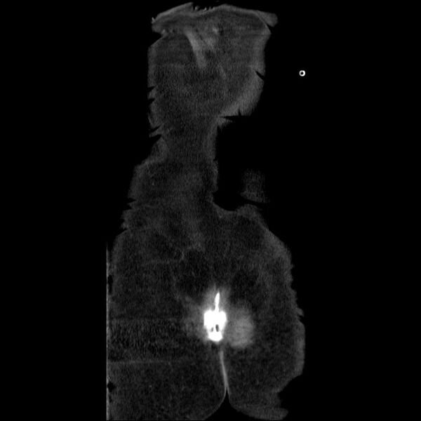 File:Acute cholecystitis and incidental left sided IVC (Radiopaedia 49352-54459 Coronal C+ portal venous phase 6).jpg