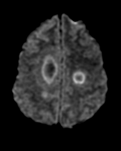 File:Acute disseminated encephalomyelitis (Radiopaedia 2576-6271 Axial DWI 1).jpg