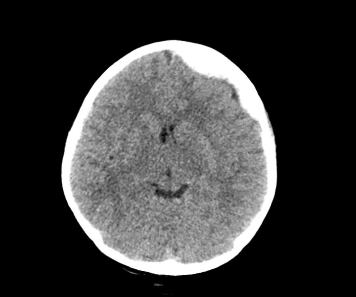 File:Acute epidural hematoma (Radiopaedia 63659-72335 Axial non-contrast 10).jpg