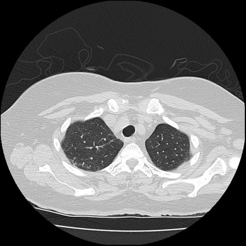 Acute interstitial pneumonitis (Radiopaedia 45404-49452 Axial lung window 15).jpg