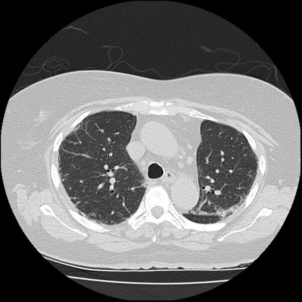File:Acute interstitial pneumonitis (Radiopaedia 45404-49452 Axial lung window 32).jpg