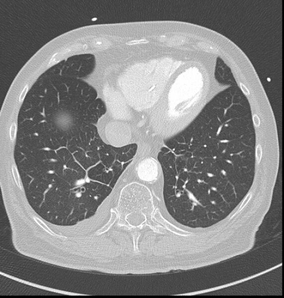 File:Acute myocardial infarction (Radiopaedia 23413-23481 lung window 55).jpg