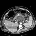 Acute pancreatic necrosis (Radiopaedia 13560-18502 Axial C+ portal venous phase 13).jpg