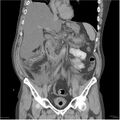 Acute pancreatitis (Radiopaedia 19135-19116 Coronal non-contrast 21).jpg