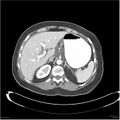 Acute pancreatitis (Radiopaedia 19136-19117 Axial C+ portal venous phase 6).jpg
