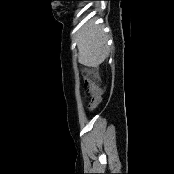 File:Acute pancreatitis (Radiopaedia 69236-79012 Sagittal C+ portal venous phase 83).jpg