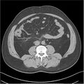 Acute pancreatitis - mild (Radiopaedia 27796-28033 Axial non-contrast 32).jpg
