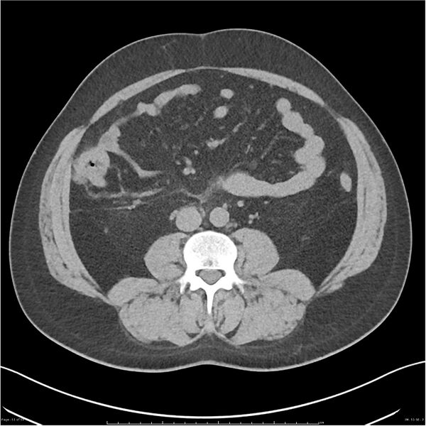 File:Acute pancreatitis - mild (Radiopaedia 27796-28033 Axial non-contrast 32).jpg