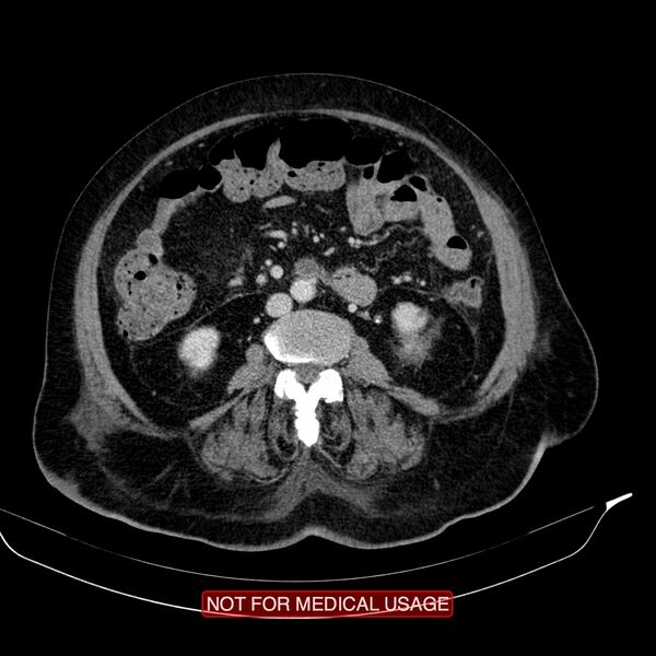 File:Acute pancreatitis with infected necrosis (Radiopaedia 26454-26585 Axial C+ portal venous phase 14).jpg
