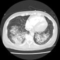 Acute pulmonary edema on CT (Radiopaedia 33582-34672 Axial lung window 39).jpg
