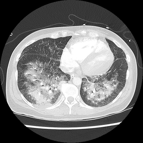 File:Acute pulmonary edema on CT (Radiopaedia 33582-34672 Axial lung window 39).jpg