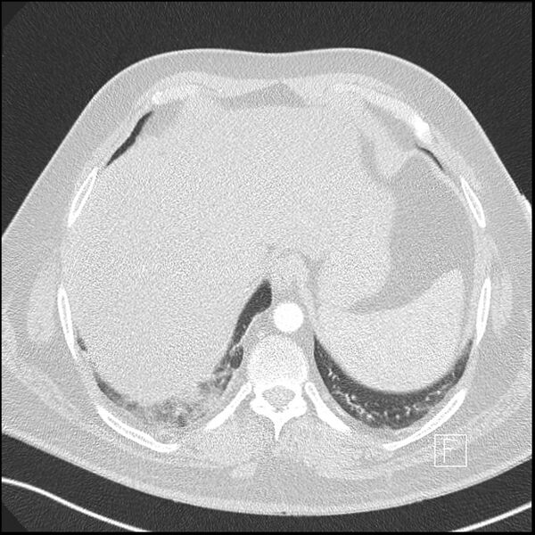 File:Acute pulmonary embolism with pulmonary infarct (Radiopaedia 73062-83768 Axial lung window 23).jpg