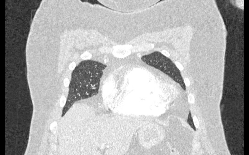 File:Acute pulmonary embolism with pulmonary infarcts (Radiopaedia 77688-89908 Coronal lung window 4).jpg