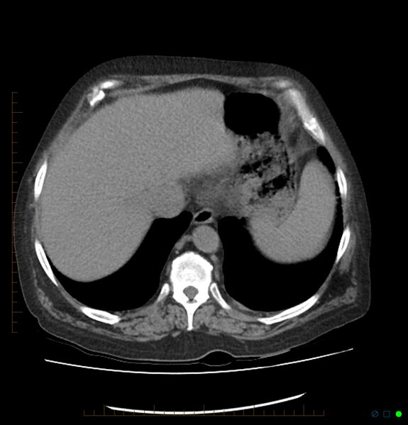 File:Acute renal failure post IV contrast injection- CT findings (Radiopaedia 47815-52557 Axial non-contrast 12).jpg