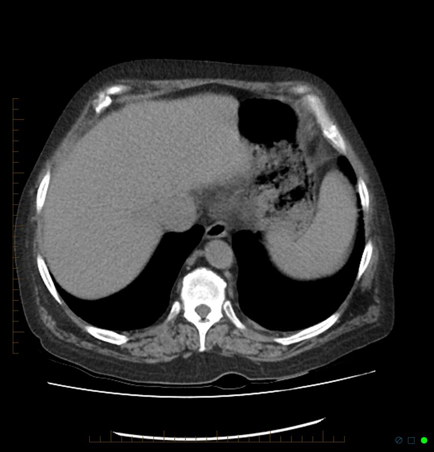 Acute renal failure post IV contrast injection- CT findings (Radiopaedia 47815-52557 Axial non-contrast 12).jpg