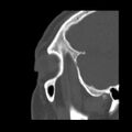 Acute sinusitis (Radiopaedia 23161-23215 Sagittal bone window 55).jpg