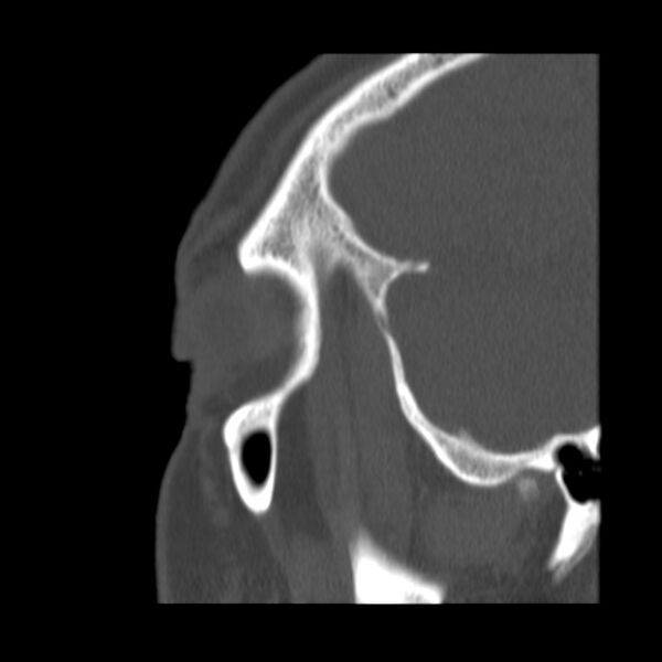File:Acute sinusitis (Radiopaedia 23161-23215 Sagittal bone window 55).jpg