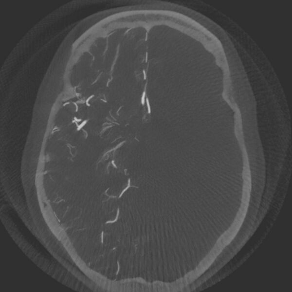 File:Acute subarachnoid hemorrhage and accessory anterior cerebral artery (Radiopaedia 69231-79010 Axial arterial - MIP 35).jpg