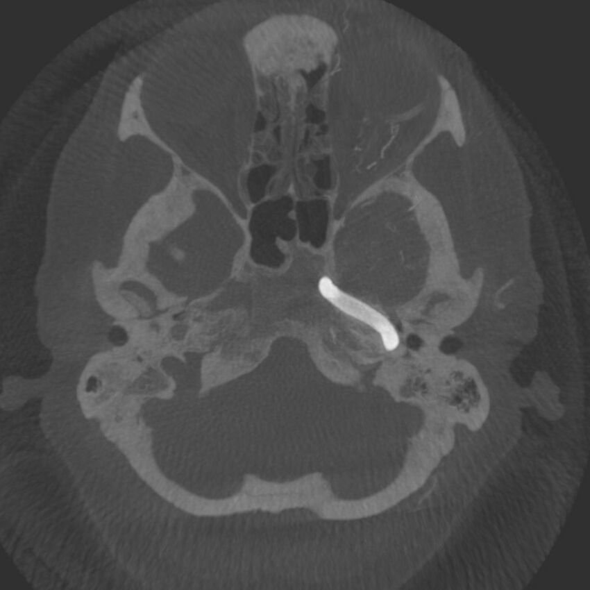 Acute subarachnoid hemorrhage and accessory anterior cerebral artery (Radiopaedia 69231-79010 C 9).jpg