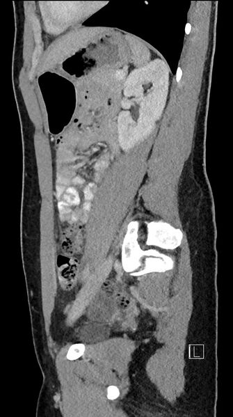 File:Acute uncomplicated appendicitis (Radiopaedia 61374-69304 Sagittal C+ portal venous phase 35).jpg