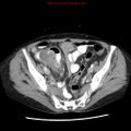 Adenocarcinoma of the colon (Radiopaedia 8191-9039 Axial liver window 61).jpg