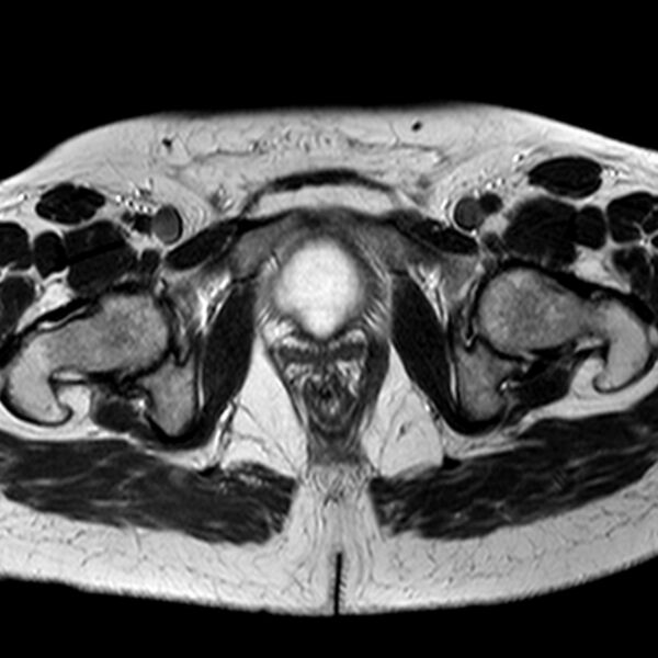 File:Adenomyoma of the uterus (Radiopaedia 9871-10439 Axial T2 7).jpg