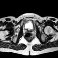Adenomyoma of the uterus (huge) (Radiopaedia 9870-10438 Axial T2 8).jpg