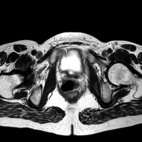 File:Adenomyoma of the uterus (huge) (Radiopaedia 9870-10438 Axial T2 8).jpg