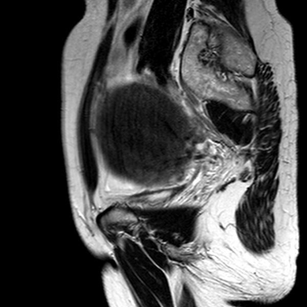 File:Adenomyoma of the uterus (huge) (Radiopaedia 9870-10438 Sagittal T2 18).jpg