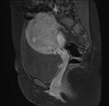 Adenomyosis - ovarian endometriomas (Radiopaedia 67031-76350 Sagittal T1 C+ fat sat 10).jpg