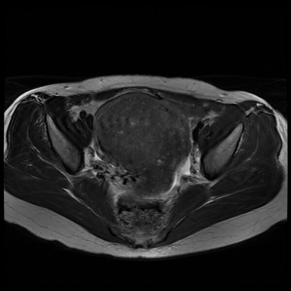 File:Adenomyosis on MRI (Radiopaedia 29328-29780 Axial T2 5).jpg