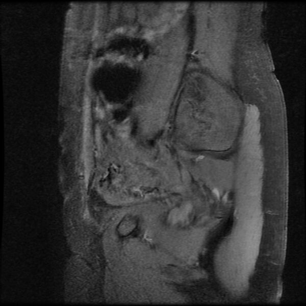 File:Adenomyosis on MRI (Radiopaedia 29328-29780 Sagittal T1 fat sat 16).jpg