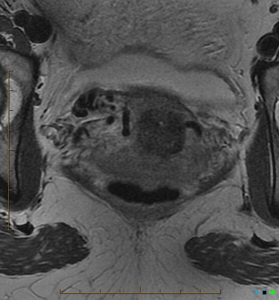 File:Adenomyosis uterus with hematometra (Radiopaedia 45779-50011 Axial T2 23).jpg