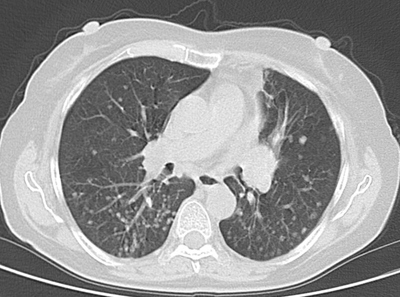 File:Adenosquamous lung carcinoma (Radiopaedia 22035-22030 lung window 31).jpg