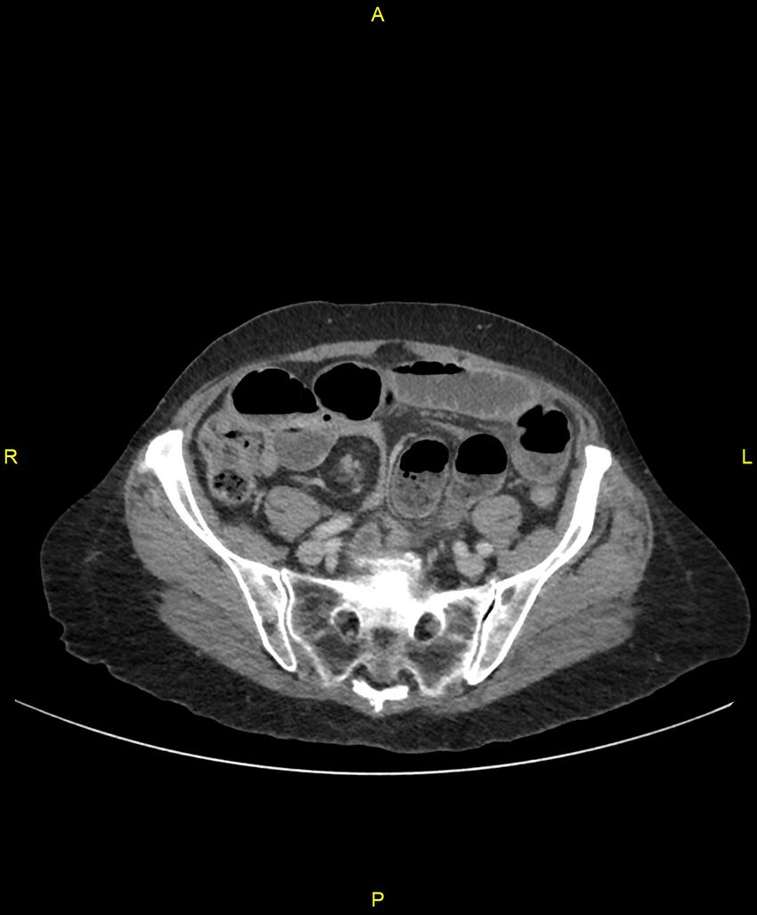 Adhesional small bowel obstruction (Radiopaedia 85402-101024 Axial C+ portal venous phase 209).jpg
