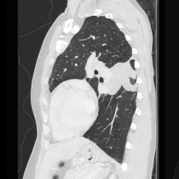 File:Allergic bronchopulmonary aspergillosis (ABPA) (Radiopaedia 5745-7414 Sagittal lung window 1).jpg