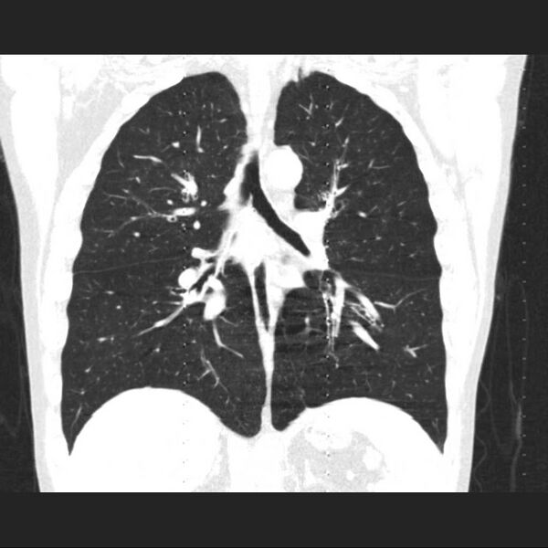 File:Allergic bronchopulmonary aspergillosis (Radiopaedia 21386-21320 Coronal lung window 10).jpg